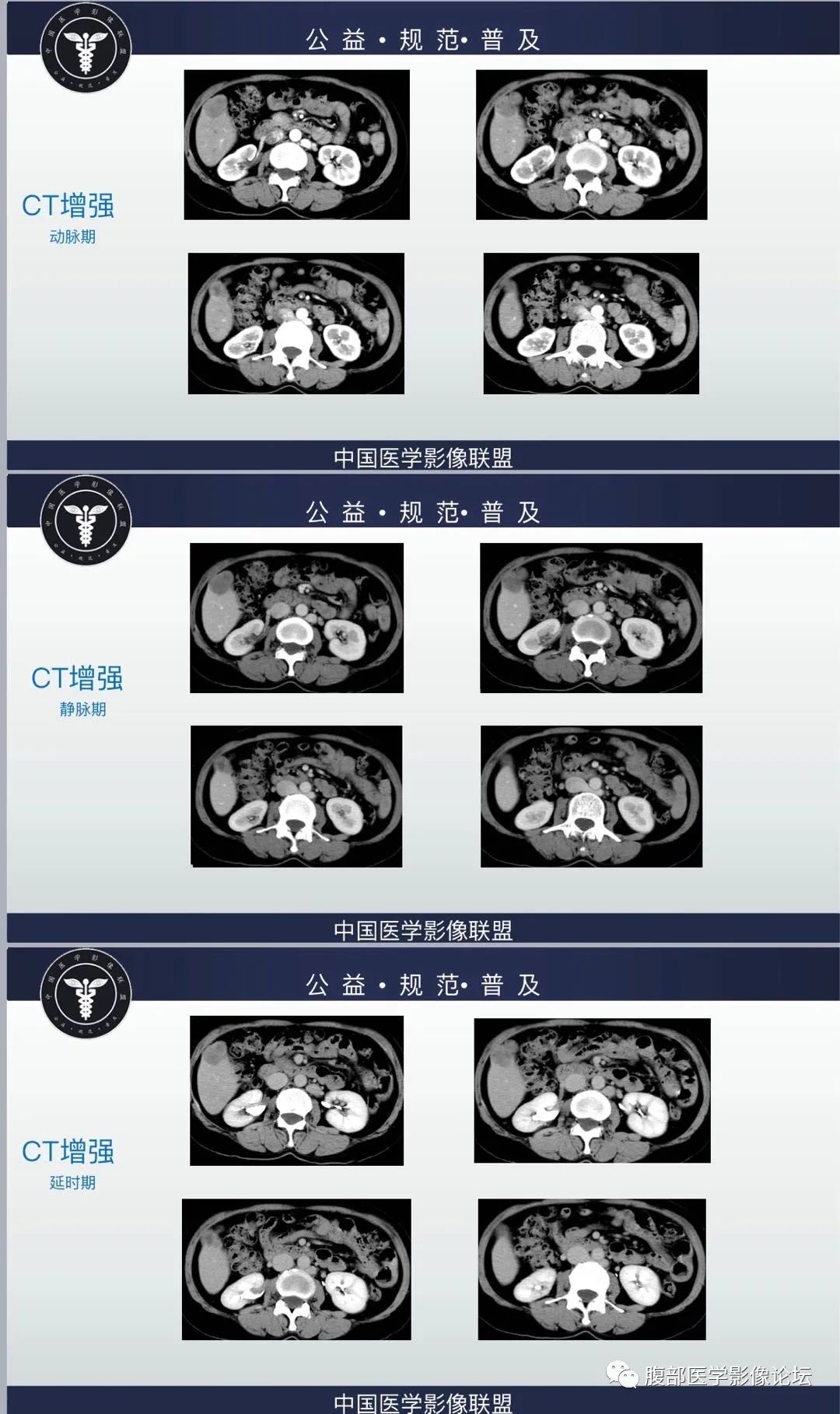 影像PPT - 【病例】低分化小细胞型肝细胞肝癌1例CT-2