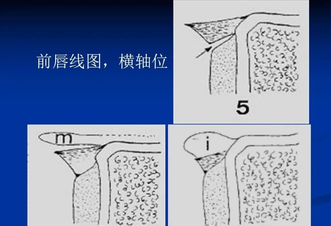 影像PPT - 肩袖解剖及损伤的临床及MRI诊断-5 影像PPT - 肩袖解剖及损伤的临床及MRI诊断-5