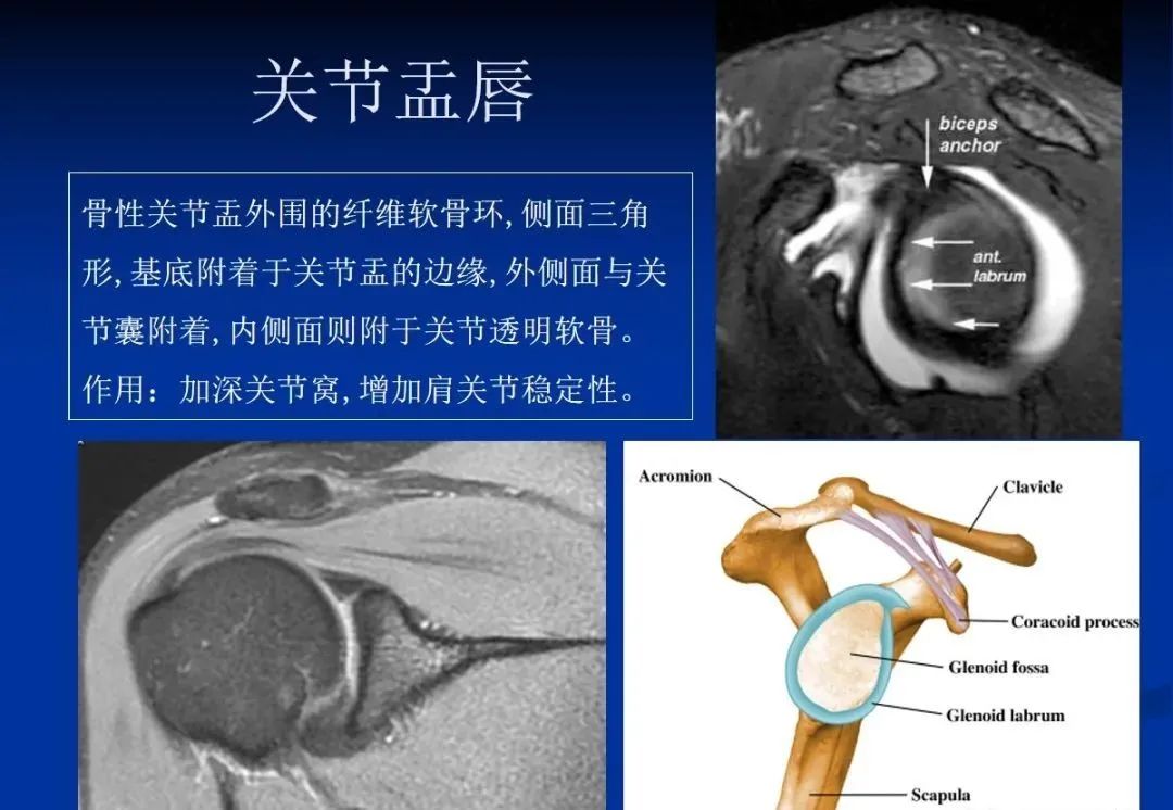 影像PPT - 肩袖解剖及损伤的临床及MRI诊断-6 影像PPT - 肩袖解剖及损伤的临床及MRI诊断-6
