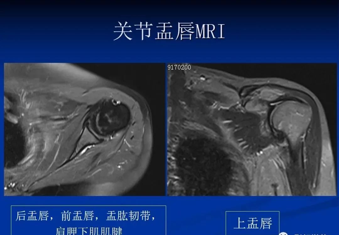 影像PPT - 肩袖解剖及损伤的临床及MRI诊断-7 影像PPT - 肩袖解剖及损伤的临床及MRI诊断-7