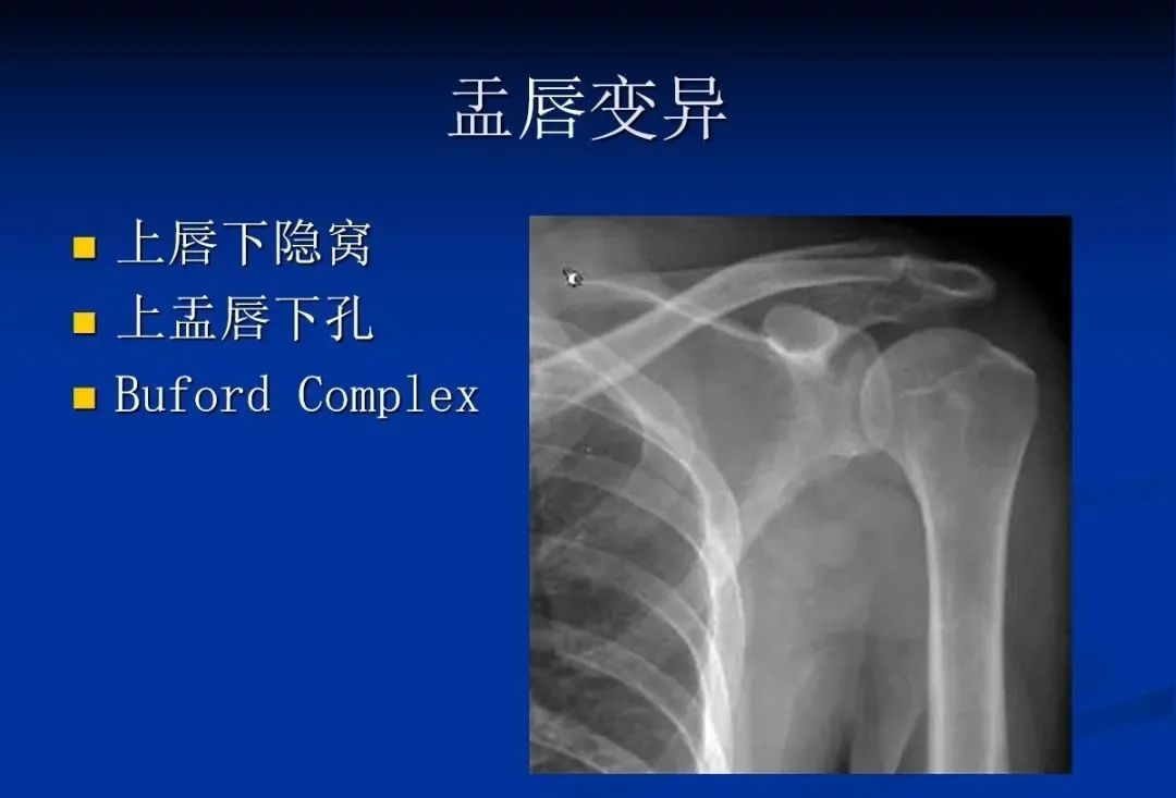 影像PPT - 肩袖解剖及损伤的临床及MRI诊断-8 影像PPT - 肩袖解剖及损伤的临床及MRI诊断-8