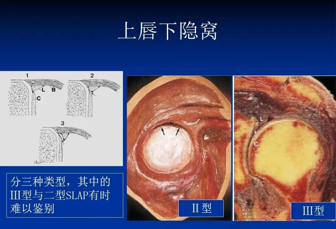 影像PPT - 肩袖解剖及损伤的临床及MRI诊断-9 影像PPT - 肩袖解剖及损伤的临床及MRI诊断-9