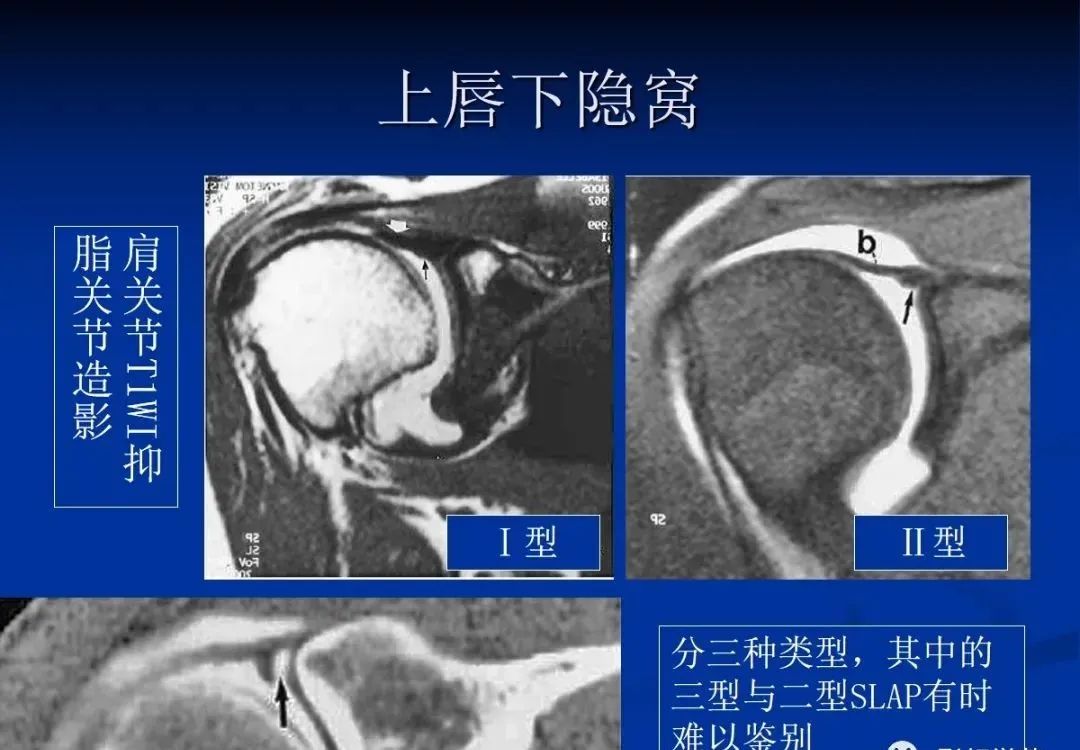 影像PPT - 肩袖解剖及损伤的临床及MRI诊断-10 影像PPT - 肩袖解剖及损伤的临床及MRI诊断-10