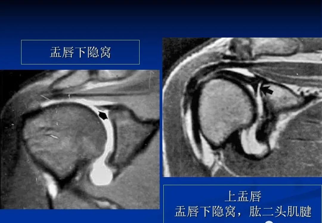 影像PPT - 肩袖解剖及损伤的临床及MRI诊断-11 影像PPT - 肩袖解剖及损伤的临床及MRI诊断-11