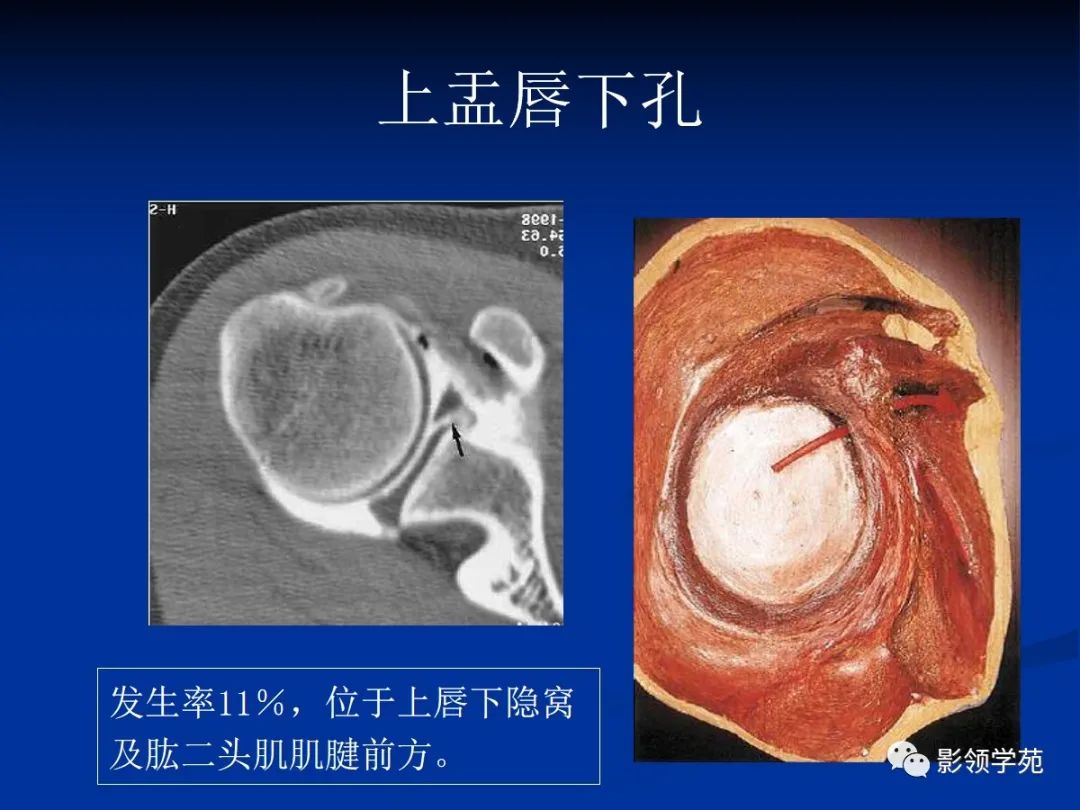 影像PPT - 肩袖解剖及损伤的临床及MRI诊断-12 影像PPT - 肩袖解剖及损伤的临床及MRI诊断-12