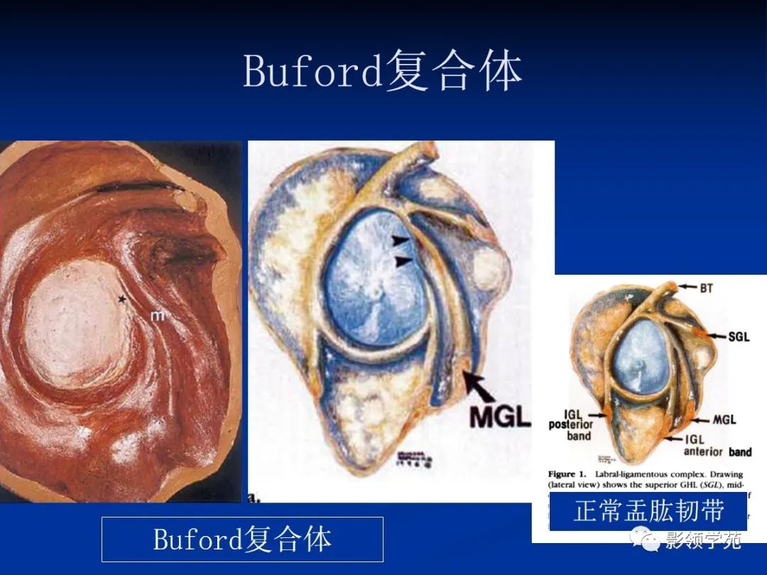 影像PPT - 肩袖解剖及损伤的临床及MRI诊断-14 影像PPT - 肩袖解剖及损伤的临床及MRI诊断-14