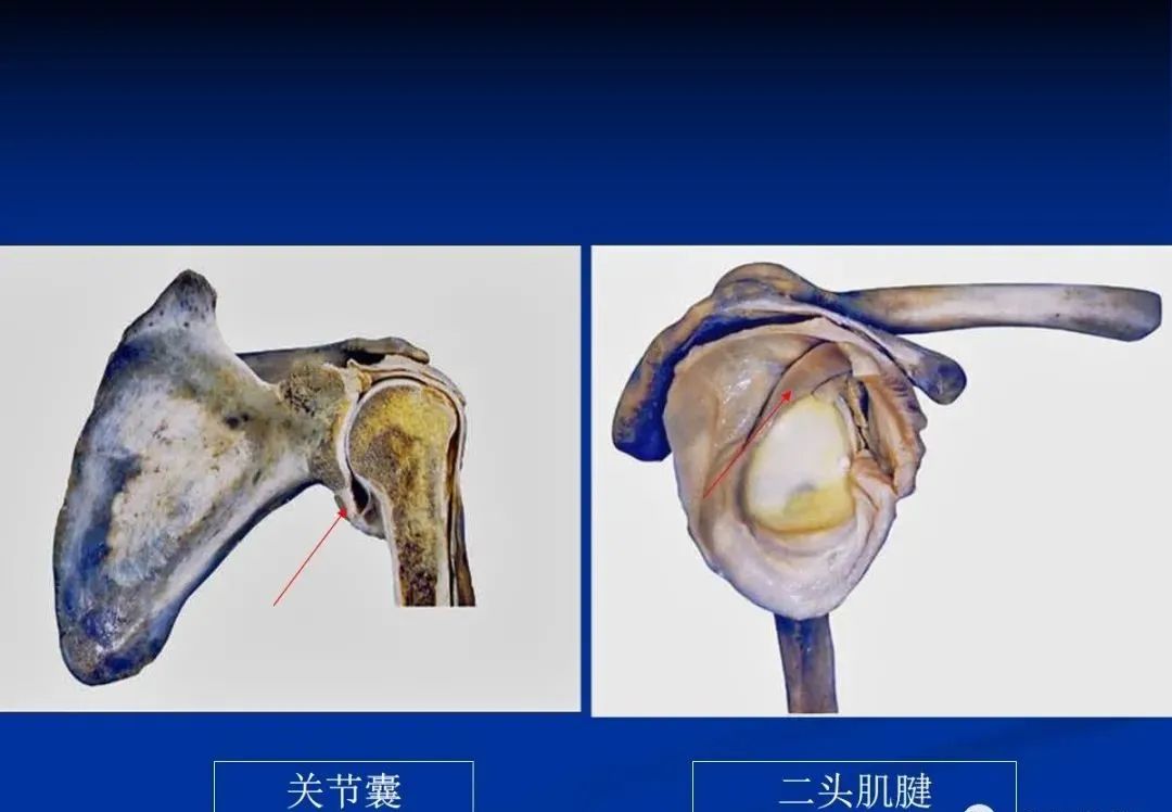 影像PPT - 肩袖解剖及损伤的临床及MRI诊断-18 影像PPT - 肩袖解剖及损伤的临床及MRI诊断-18