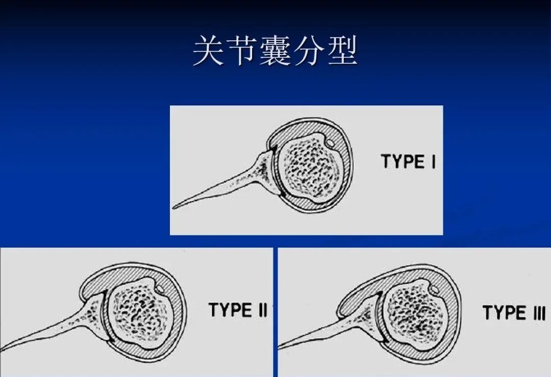 影像PPT - 肩袖解剖及损伤的临床及MRI诊断-20 影像PPT - 肩袖解剖及损伤的临床及MRI诊断-20