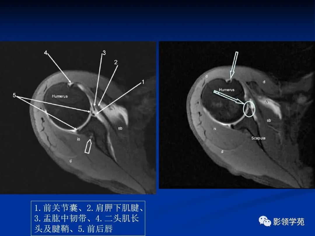 影像PPT - 肩袖解剖及损伤的临床及MRI诊断-21 影像PPT - 肩袖解剖及损伤的临床及MRI诊断-21
