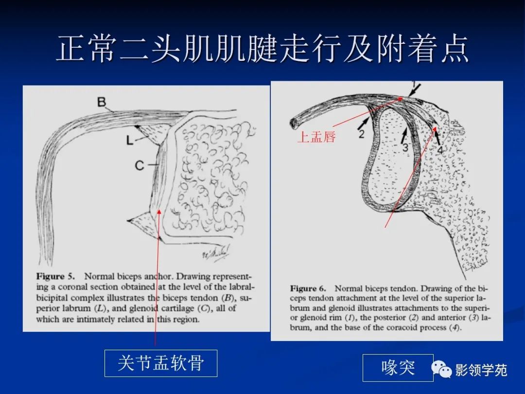 影像PPT - 肩袖解剖及损伤的临床及MRI诊断-23 影像PPT - 肩袖解剖及损伤的临床及MRI诊断-23