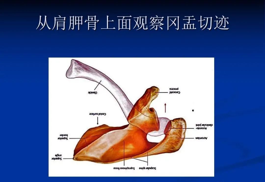影像PPT - 肩袖解剖及损伤的临床及MRI诊断-25 影像PPT - 肩袖解剖及损伤的临床及MRI诊断-25