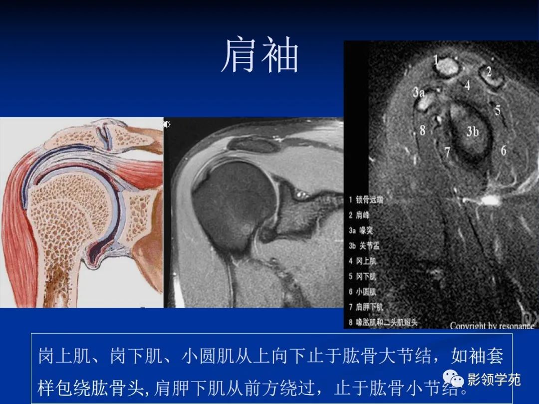 影像PPT - 肩袖解剖及损伤的临床及MRI诊断-28 影像PPT - 肩袖解剖及损伤的临床及MRI诊断-28