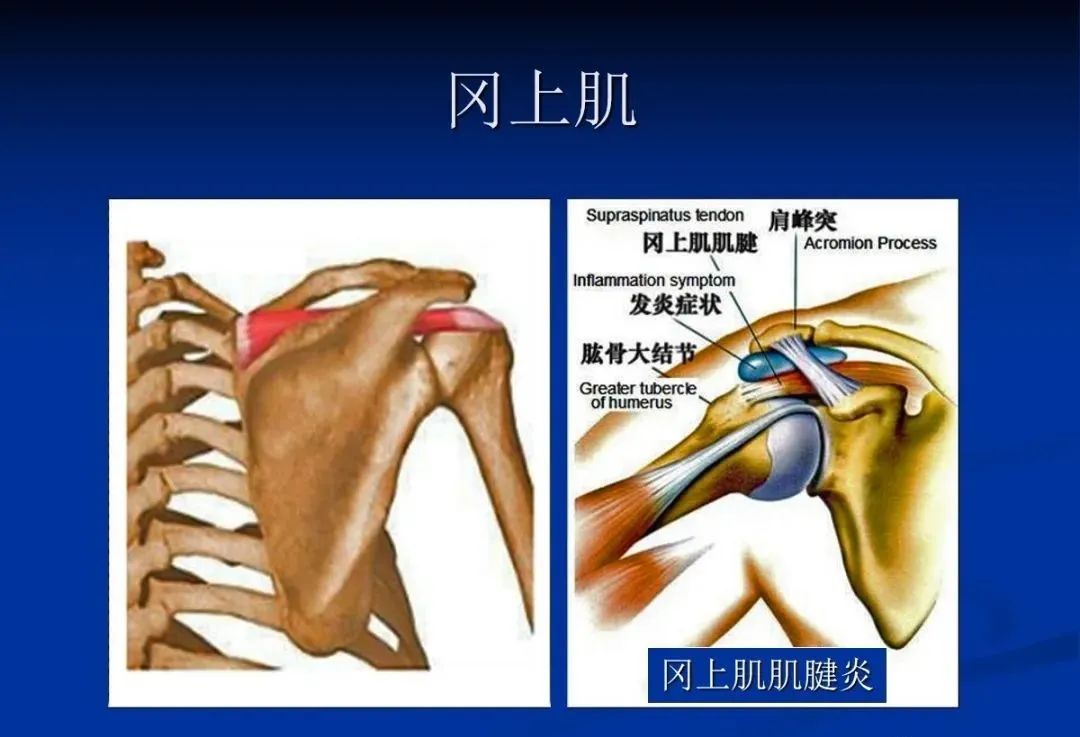影像PPT - 肩袖解剖及损伤的临床及MRI诊断-31 影像PPT - 肩袖解剖及损伤的临床及MRI诊断-31