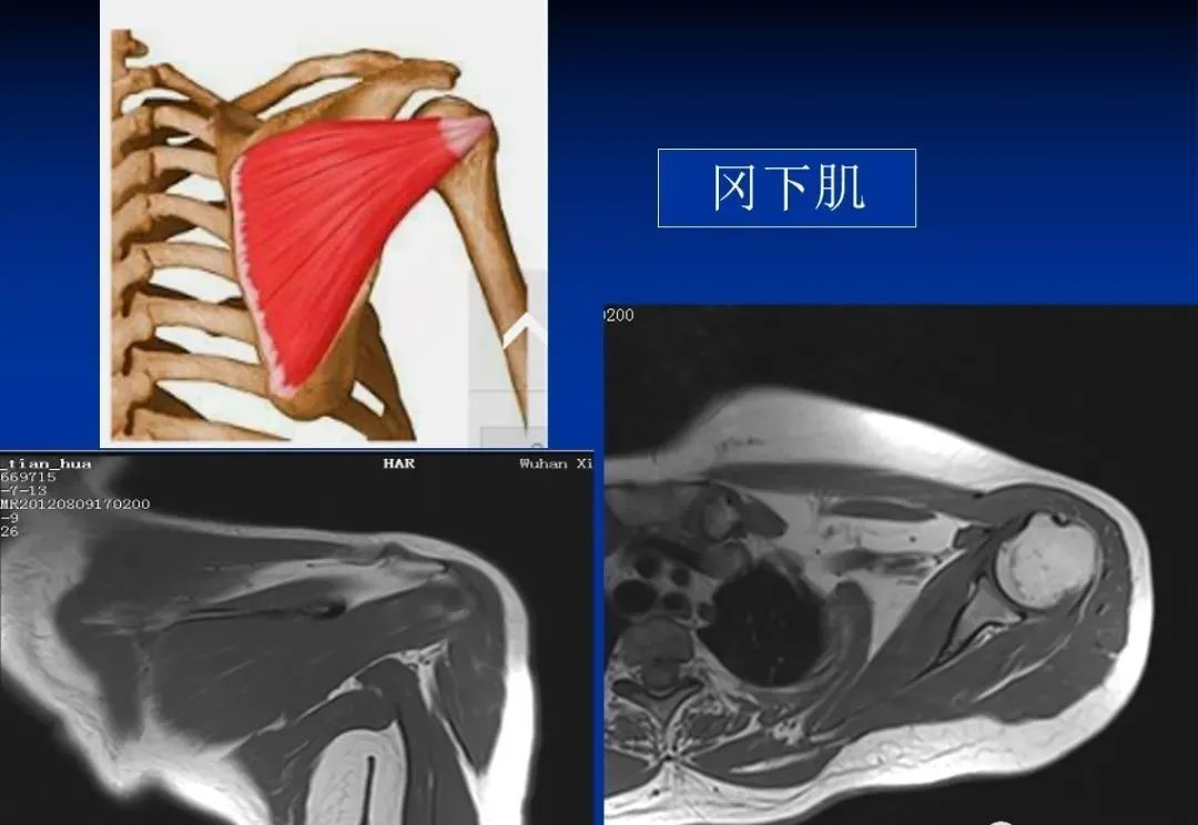 影像PPT - 肩袖解剖及损伤的临床及MRI诊断-33 影像PPT - 肩袖解剖及损伤的临床及MRI诊断-33