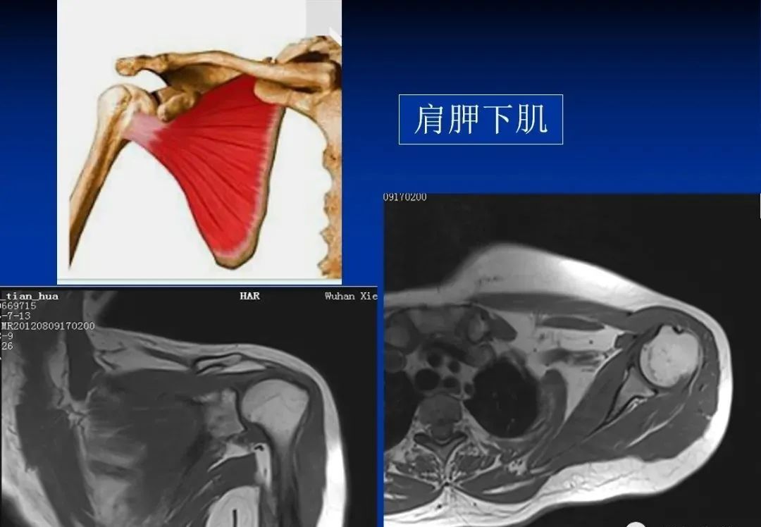 影像PPT - 肩袖解剖及损伤的临床及MRI诊断-36 影像PPT - 肩袖解剖及损伤的临床及MRI诊断-36