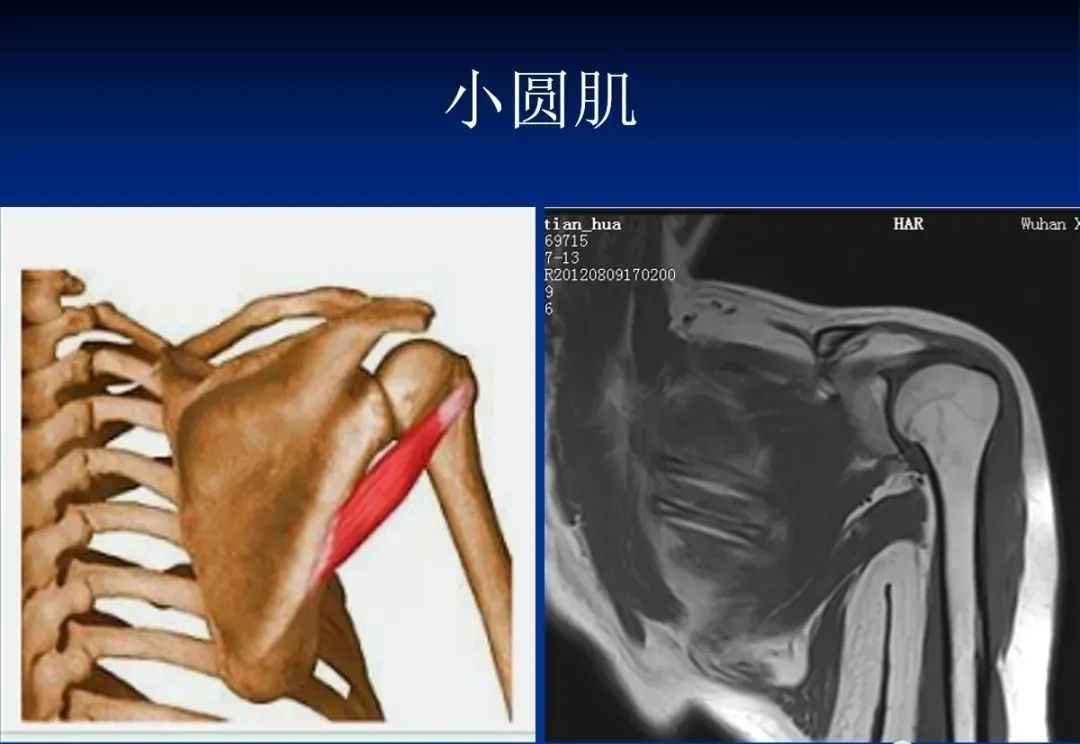 影像PPT - 肩袖解剖及损伤的临床及MRI诊断-37 影像PPT - 肩袖解剖及损伤的临床及MRI诊断-37