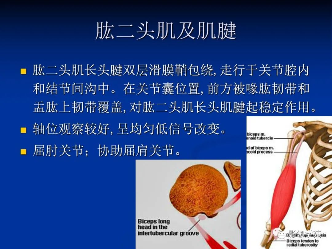 影像PPT - 肩袖解剖及损伤的临床及MRI诊断-43 影像PPT - 肩袖解剖及损伤的临床及MRI诊断-43