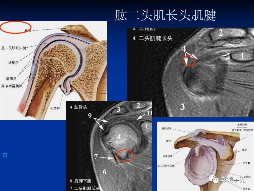 影像PPT - 肩袖解剖及损伤的临床及MRI诊断-45 影像PPT - 肩袖解剖及损伤的临床及MRI诊断-45