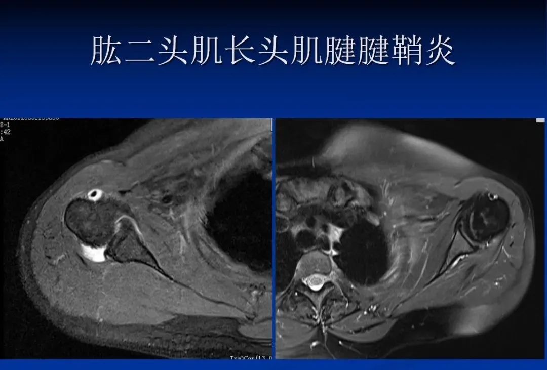 影像PPT - 肩袖解剖及损伤的临床及MRI诊断-47 影像PPT - 肩袖解剖及损伤的临床及MRI诊断-47