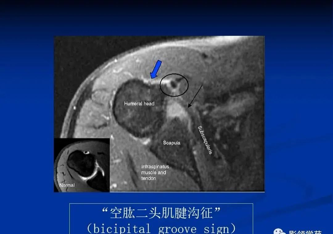 影像PPT - 肩袖解剖及损伤的临床及MRI诊断-49 影像PPT - 肩袖解剖及损伤的临床及MRI诊断-49