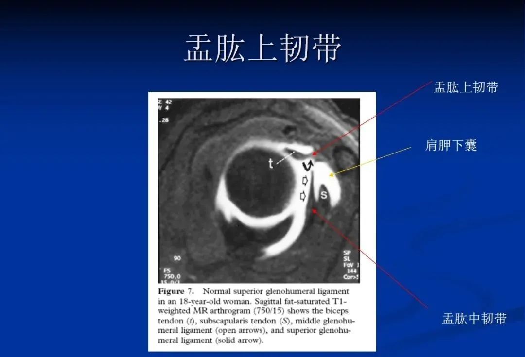 影像PPT - 肩袖解剖及损伤的临床及MRI诊断-57 影像PPT - 肩袖解剖及损伤的临床及MRI诊断-57
