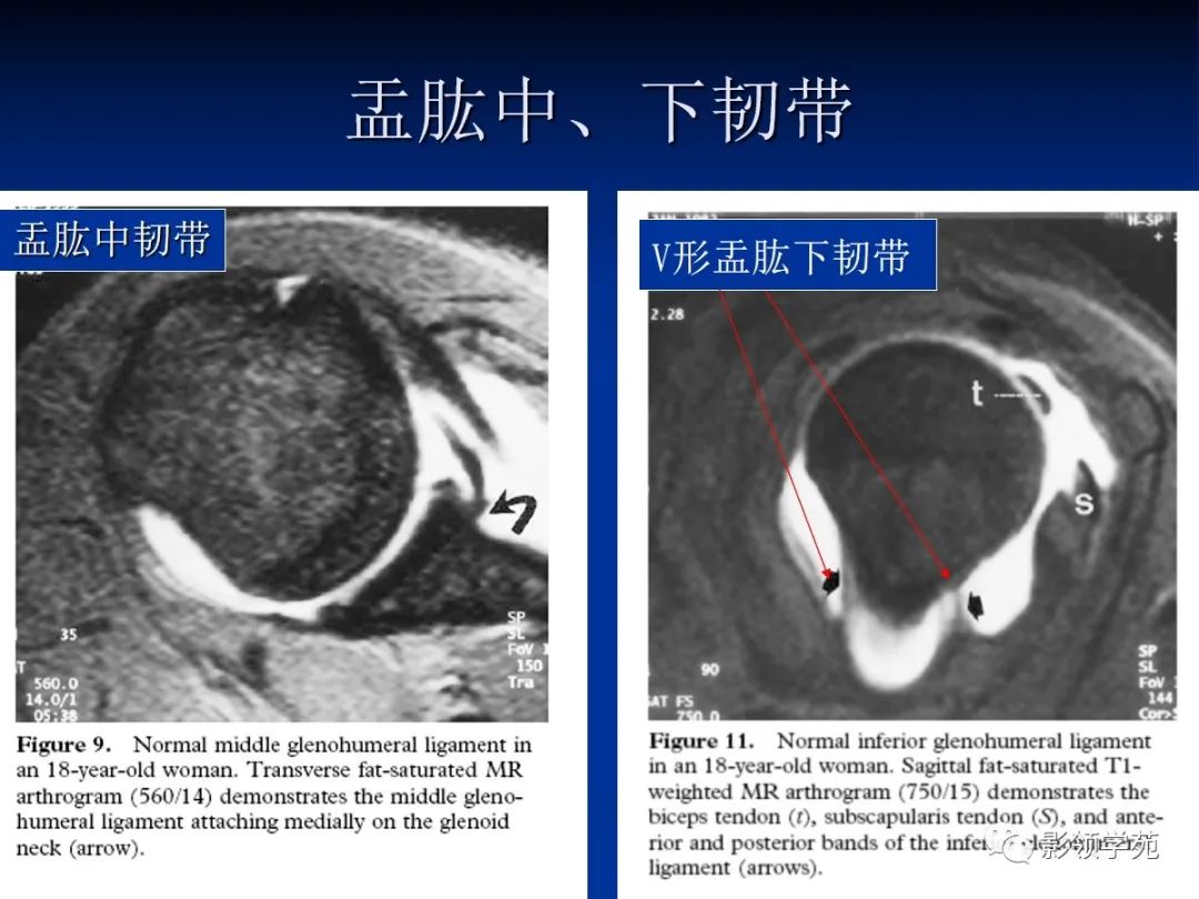 影像PPT - 肩袖解剖及损伤的临床及MRI诊断-58 影像PPT - 肩袖解剖及损伤的临床及MRI诊断-58