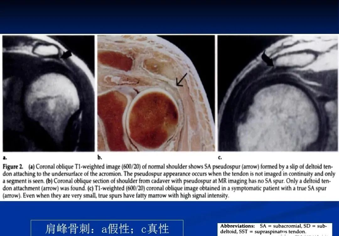 影像PPT - 肩袖解剖及损伤的临床及MRI诊断-60 影像PPT - 肩袖解剖及损伤的临床及MRI诊断-60