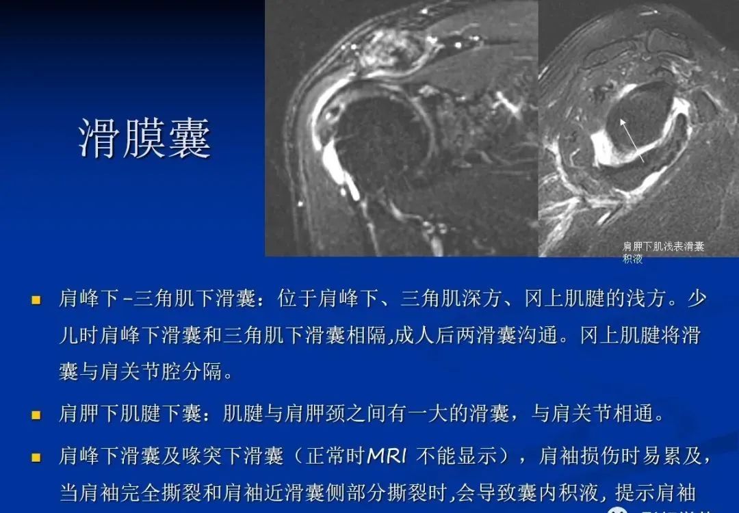 影像PPT - 肩袖解剖及损伤的临床及MRI诊断-62 影像PPT - 肩袖解剖及损伤的临床及MRI诊断-62