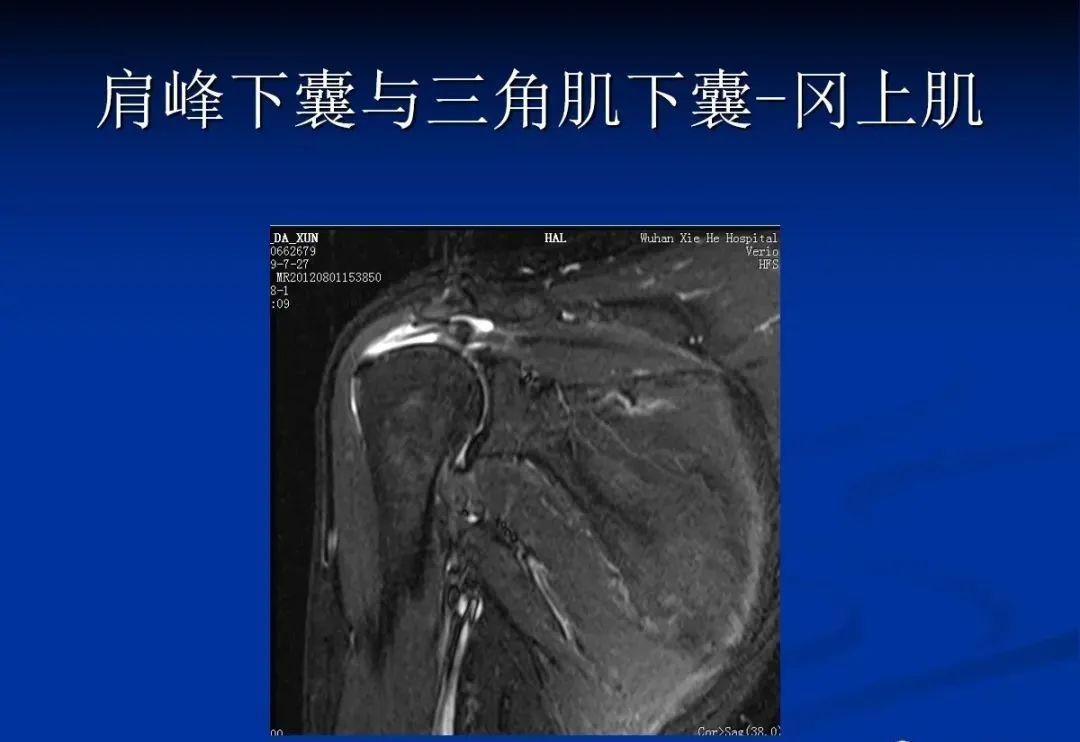 影像PPT - 肩袖解剖及损伤的临床及MRI诊断-68 影像PPT - 肩袖解剖及损伤的临床及MRI诊断-68