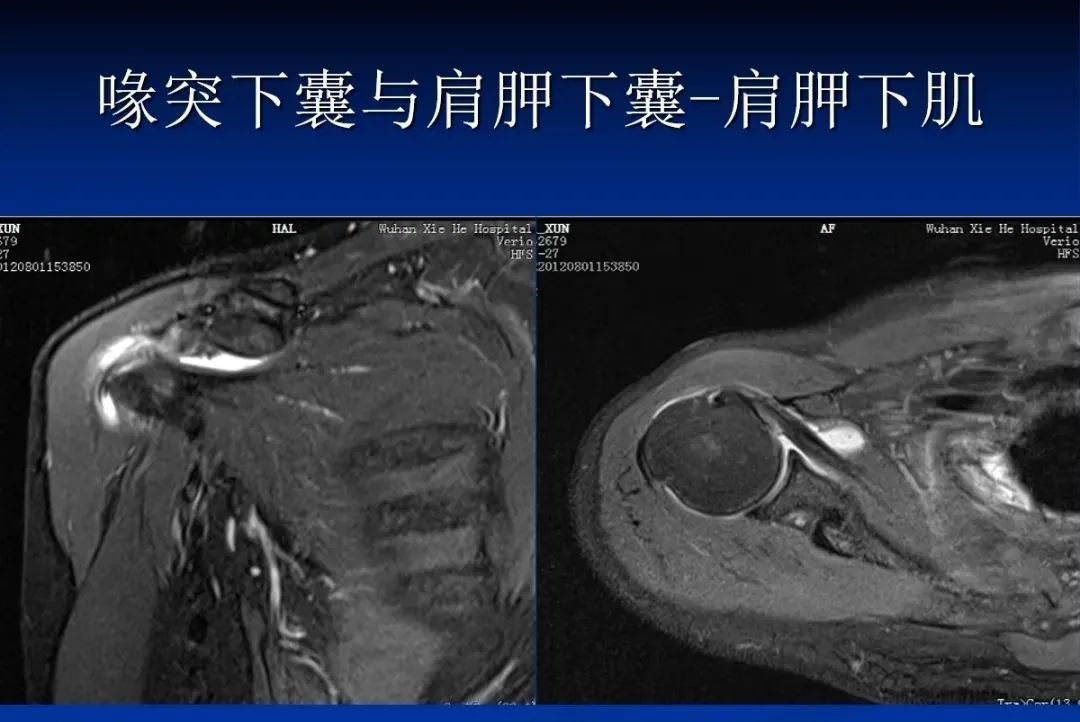 影像PPT - 肩袖解剖及损伤的临床及MRI诊断-69 影像PPT - 肩袖解剖及损伤的临床及MRI诊断-69