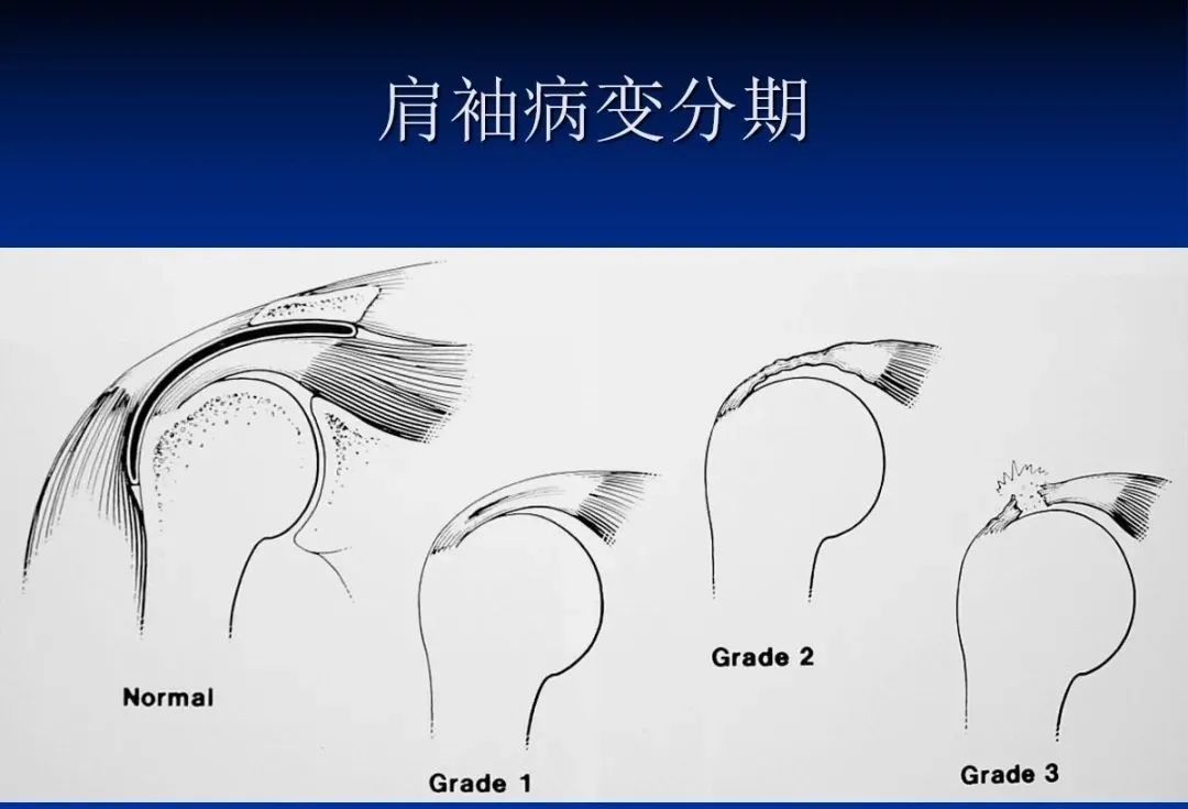 影像PPT - 肩袖解剖及损伤的临床及MRI诊断-75 影像PPT - 肩袖解剖及损伤的临床及MRI诊断-75