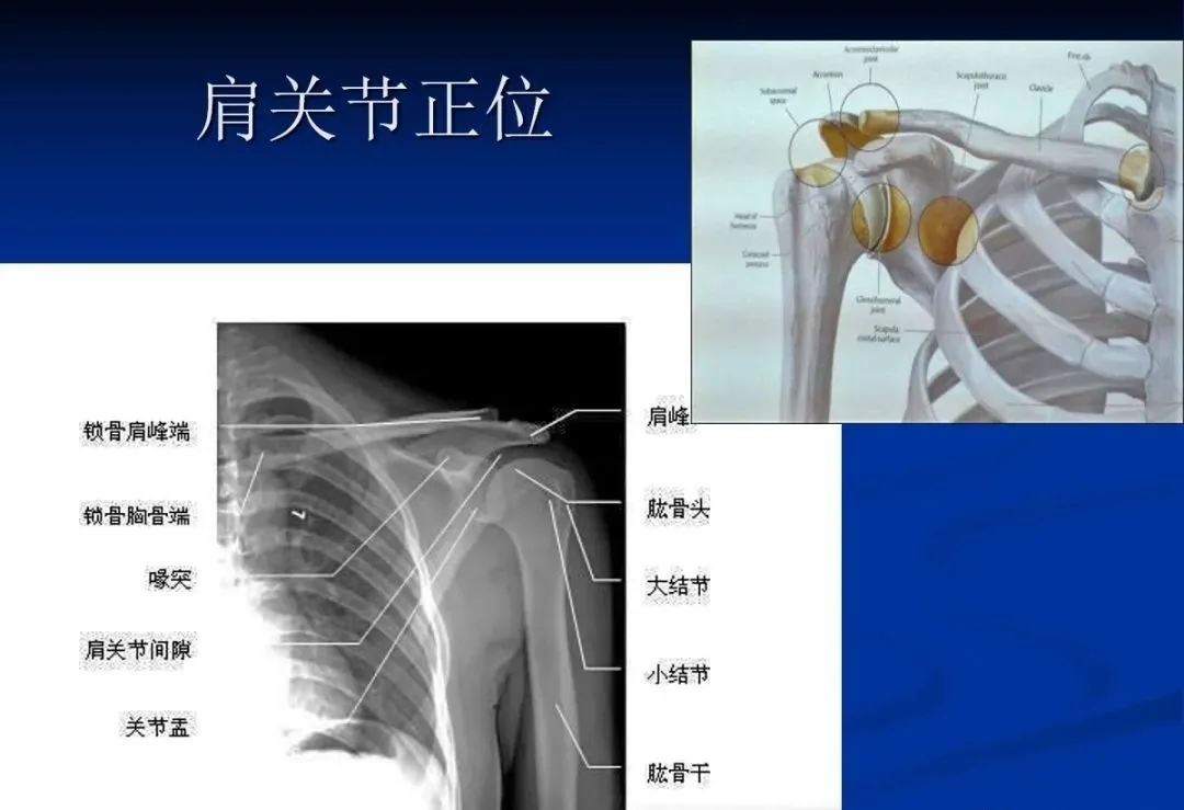 影像PPT - 肩袖解剖及损伤的临床及MRI诊断-98 影像PPT - 肩袖解剖及损伤的临床及MRI诊断-98