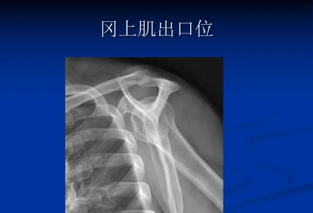 影像PPT - 肩袖解剖及损伤的临床及MRI诊断-100 影像PPT - 肩袖解剖及损伤的临床及MRI诊断-100