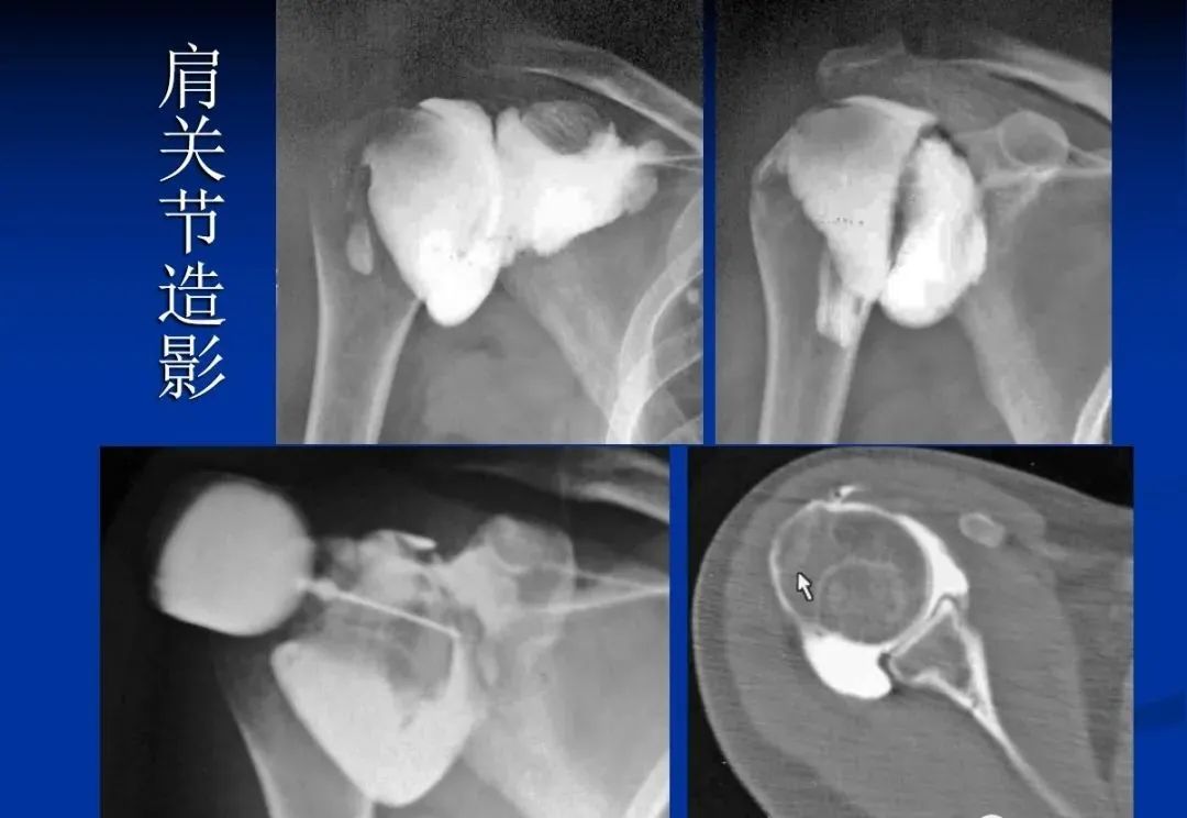 影像PPT - 肩袖解剖及损伤的临床及MRI诊断-109 影像PPT - 肩袖解剖及损伤的临床及MRI诊断-109