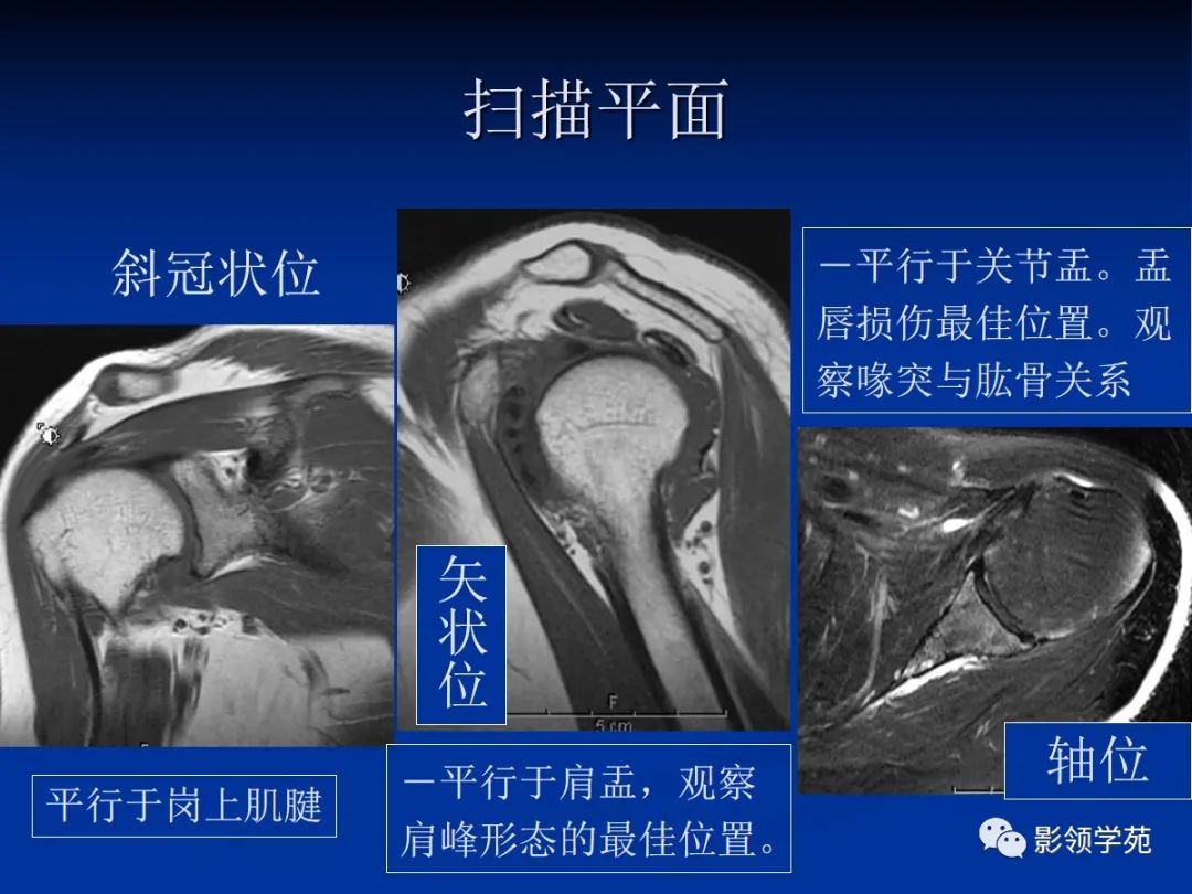 影像PPT - 肩袖解剖及损伤的临床及MRI诊断-117 影像PPT - 肩袖解剖及损伤的临床及MRI诊断-117