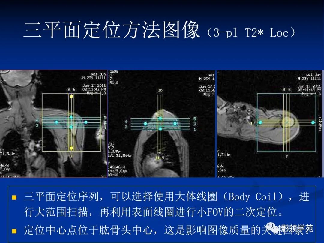 影像PPT - 肩袖解剖及损伤的临床及MRI诊断-120 影像PPT - 肩袖解剖及损伤的临床及MRI诊断-120