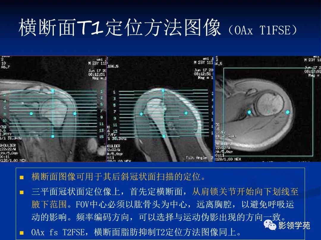 影像PPT - 肩袖解剖及损伤的临床及MRI诊断-121 影像PPT - 肩袖解剖及损伤的临床及MRI诊断-121