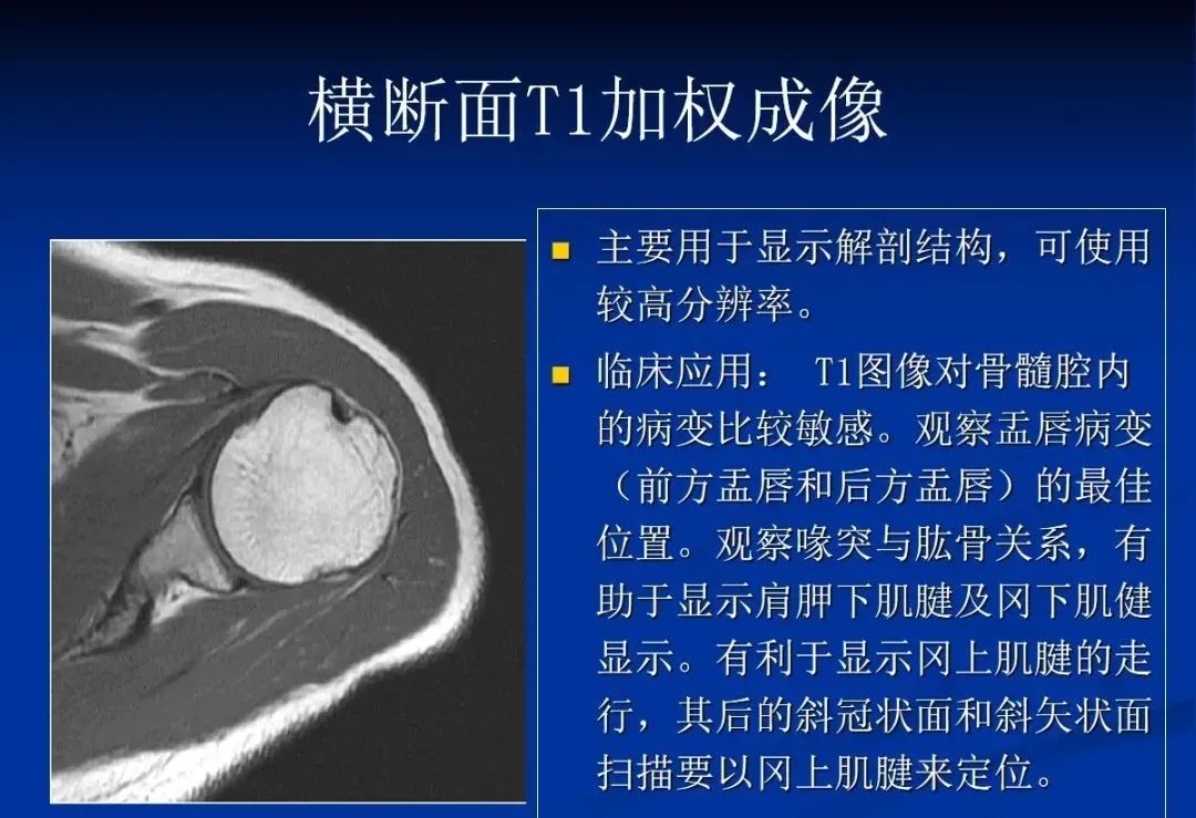 影像PPT - 肩袖解剖及损伤的临床及MRI诊断-122 影像PPT - 肩袖解剖及损伤的临床及MRI诊断-122