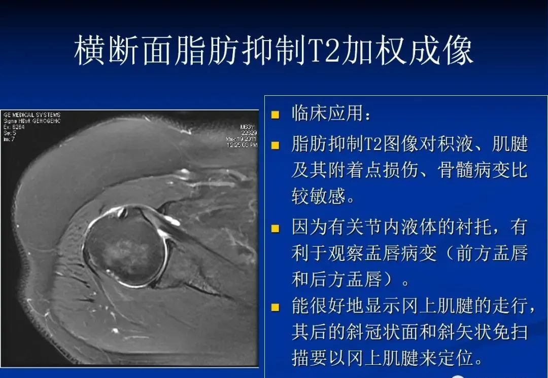 影像PPT - 肩袖解剖及损伤的临床及MRI诊断-123 影像PPT - 肩袖解剖及损伤的临床及MRI诊断-123