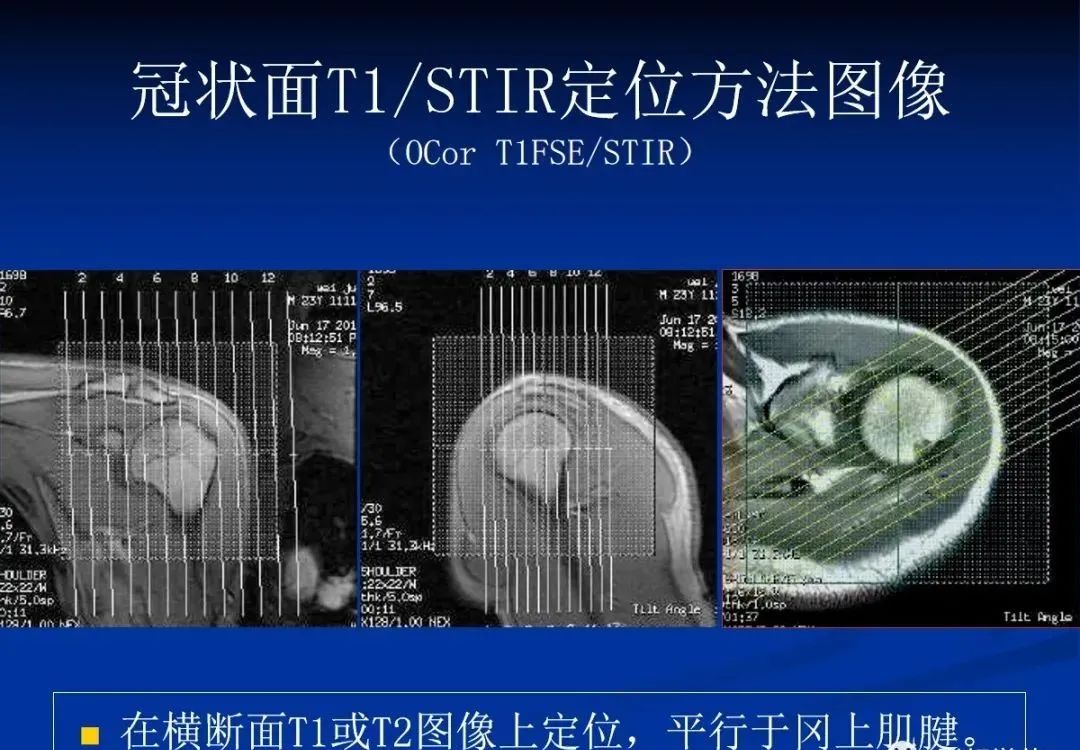 影像PPT - 肩袖解剖及损伤的临床及MRI诊断-124 影像PPT - 肩袖解剖及损伤的临床及MRI诊断-124