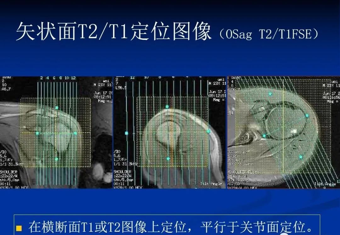 影像PPT - 肩袖解剖及损伤的临床及MRI诊断-128 影像PPT - 肩袖解剖及损伤的临床及MRI诊断-128