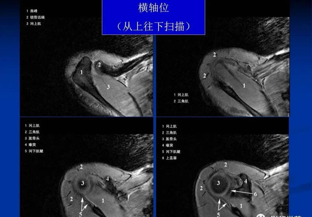 影像PPT - 肩袖解剖及损伤的临床及MRI诊断-132 影像PPT - 肩袖解剖及损伤的临床及MRI诊断-132