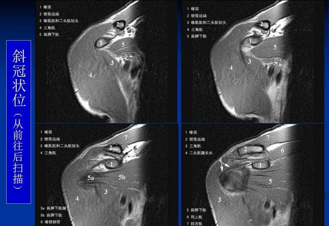 影像PPT - 肩袖解剖及损伤的临床及MRI诊断-135 影像PPT - 肩袖解剖及损伤的临床及MRI诊断-135