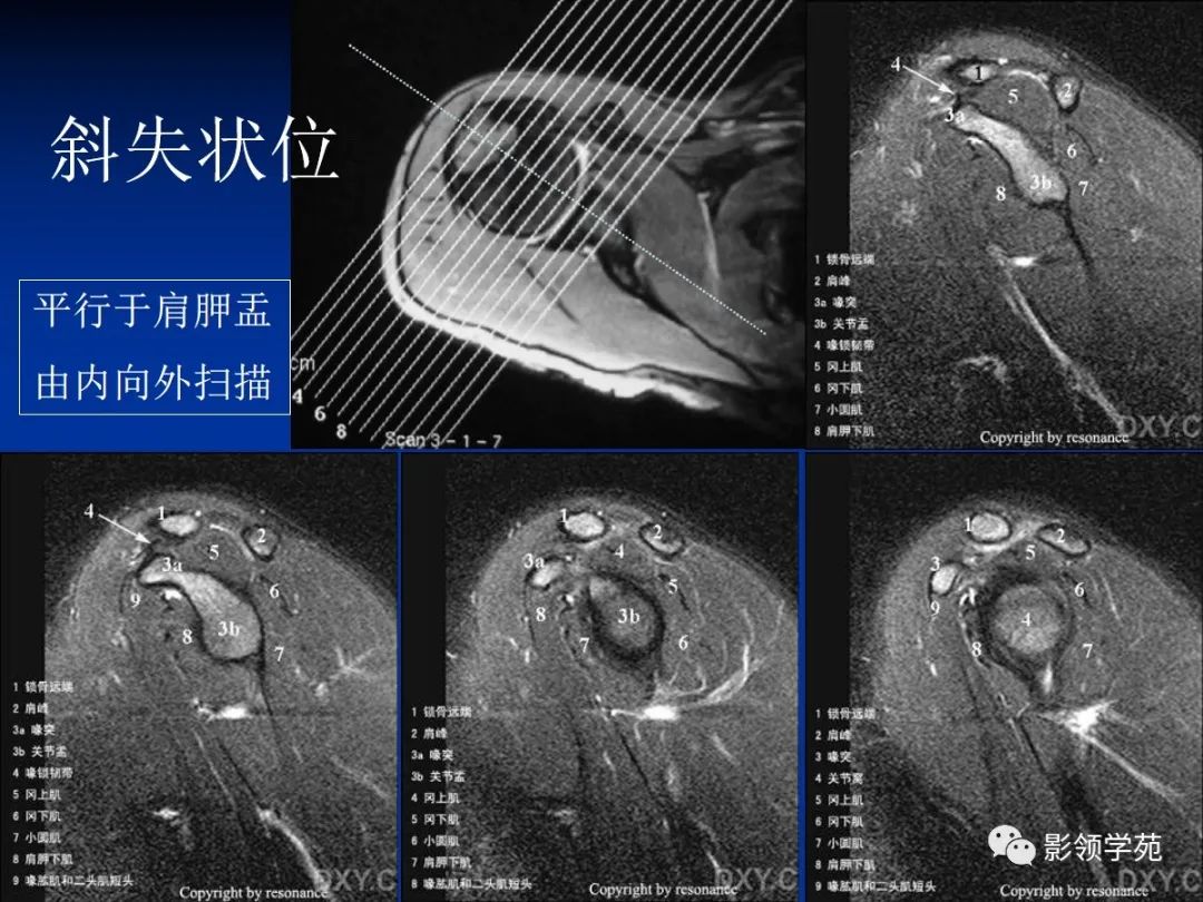 影像PPT - 肩袖解剖及损伤的临床及MRI诊断-138 影像PPT - 肩袖解剖及损伤的临床及MRI诊断-138