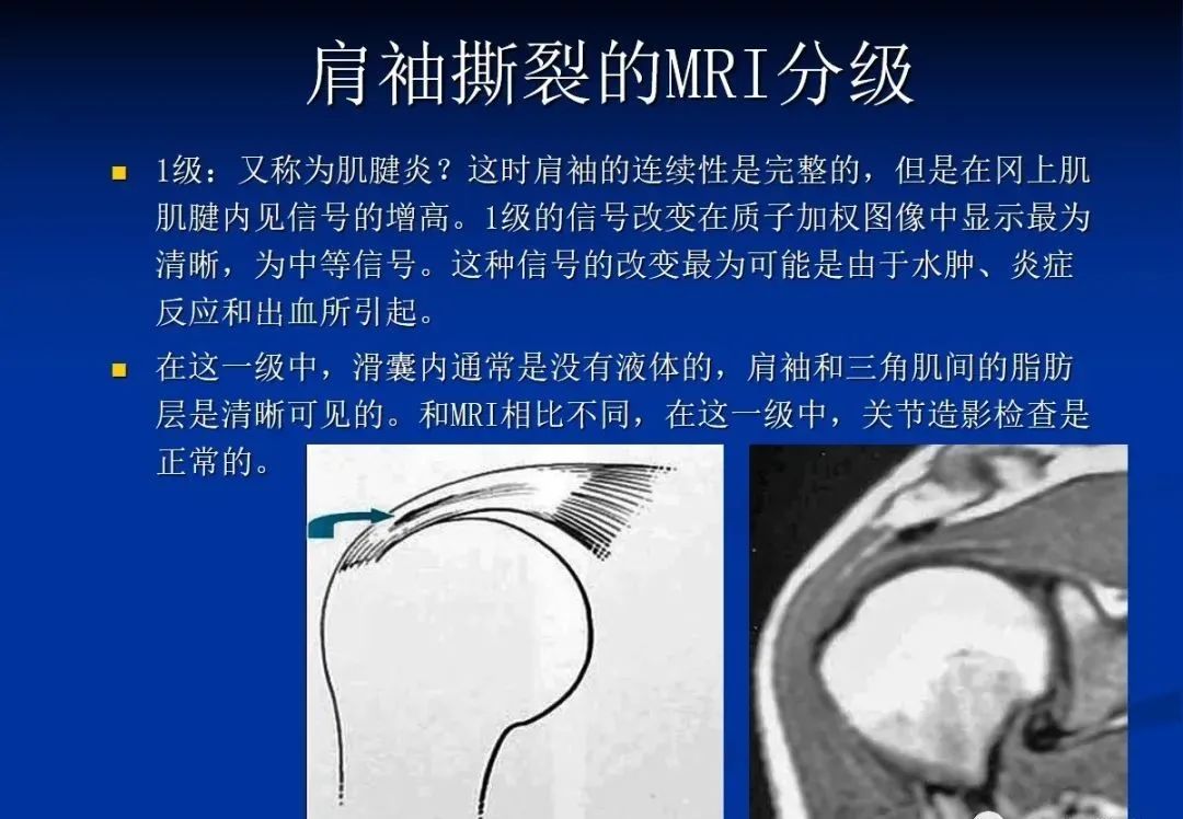 影像PPT - 肩袖解剖及损伤的临床及MRI诊断-144 影像PPT - 肩袖解剖及损伤的临床及MRI诊断-144