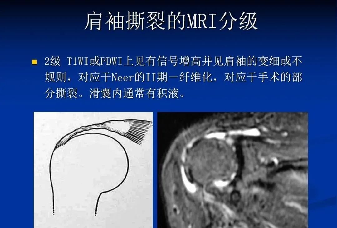 影像PPT - 肩袖解剖及损伤的临床及MRI诊断-145 影像PPT - 肩袖解剖及损伤的临床及MRI诊断-145
