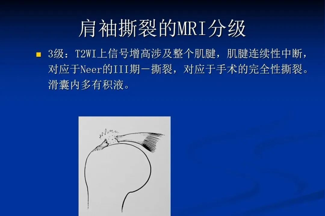 影像PPT - 肩袖解剖及损伤的临床及MRI诊断-146 影像PPT - 肩袖解剖及损伤的临床及MRI诊断-146