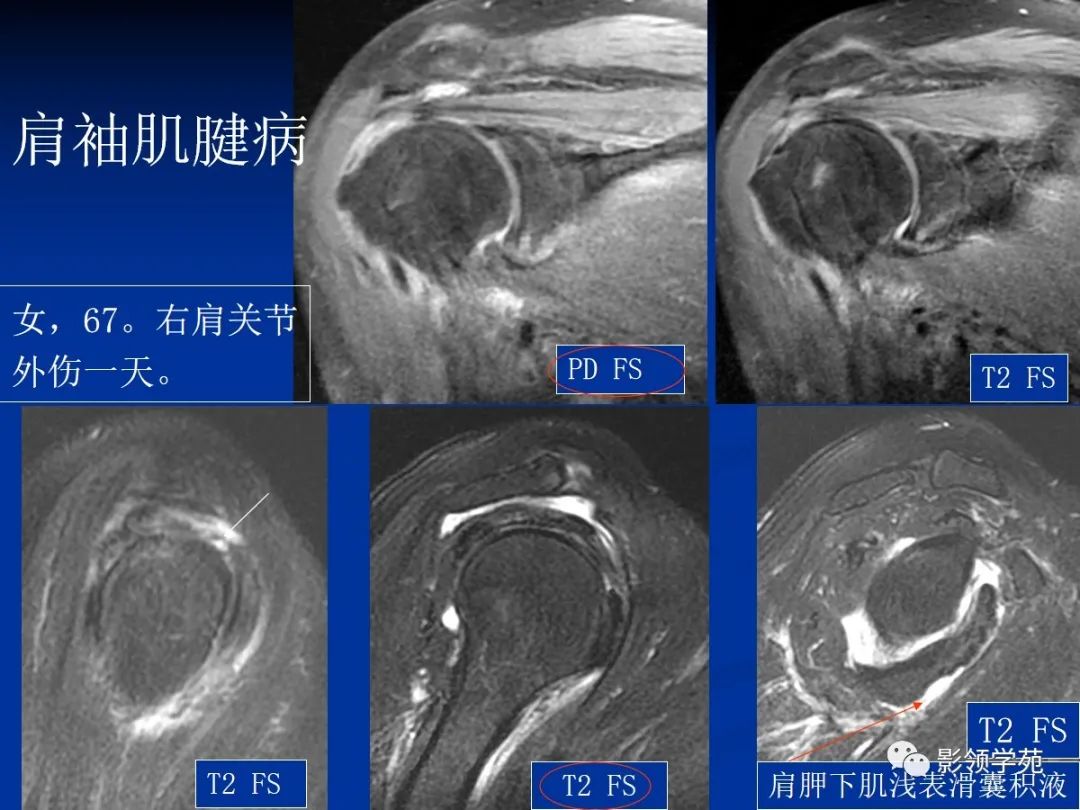 影像PPT - 肩袖解剖及损伤的临床及MRI诊断-153 影像PPT - 肩袖解剖及损伤的临床及MRI诊断-153