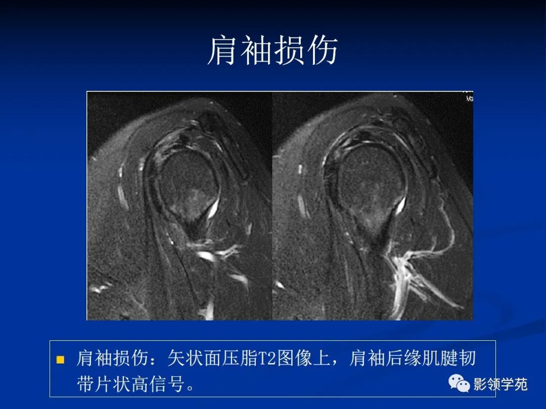影像PPT - 肩袖解剖及损伤的临床及MRI诊断-154 影像PPT - 肩袖解剖及损伤的临床及MRI诊断-154