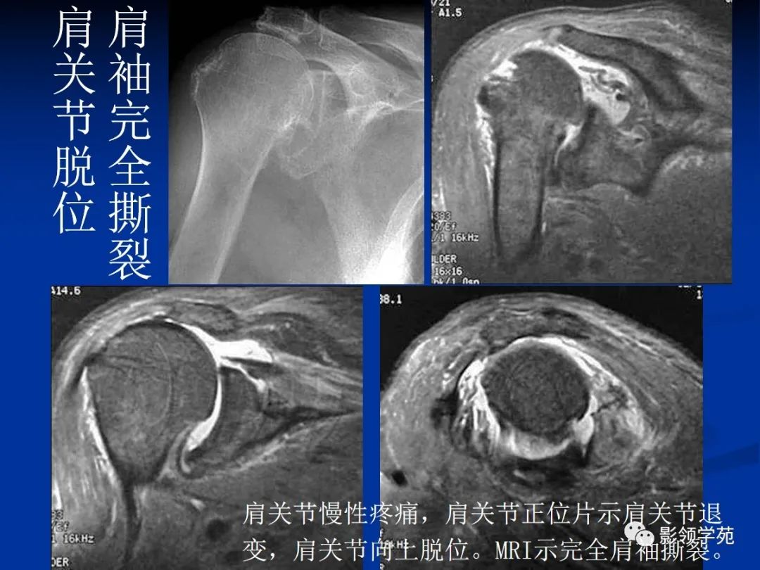 影像PPT - 肩袖解剖及损伤的临床及MRI诊断-157 影像PPT - 肩袖解剖及损伤的临床及MRI诊断-157